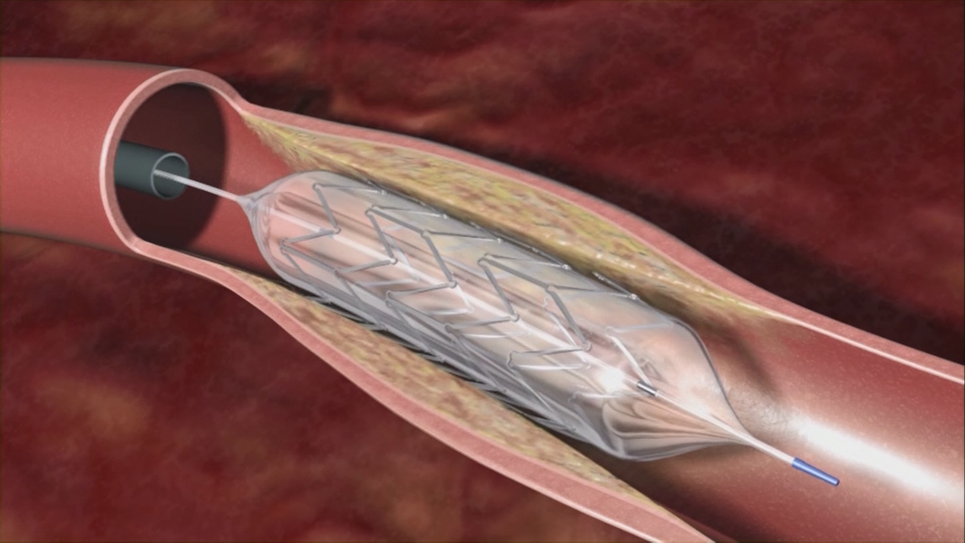 Real Men Wear Gowns: Heart stents can prevent serious health problems ...